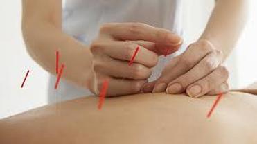 acupuncturist inserting needles to treat back pain