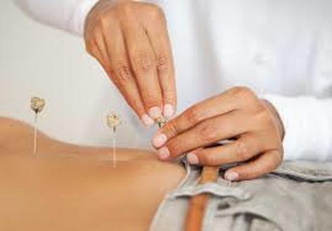 Acupuncturist applying needle top moxa to patients abdomen.